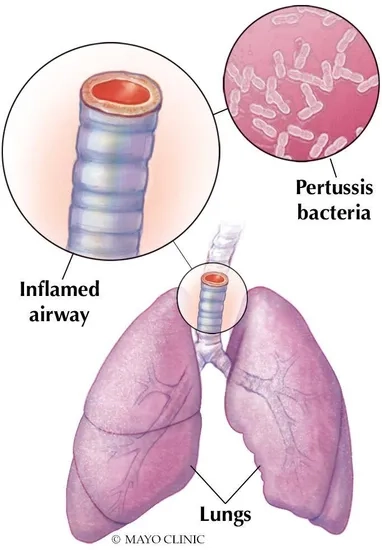 This is a graphic showing an illustration of a respiratory infection.